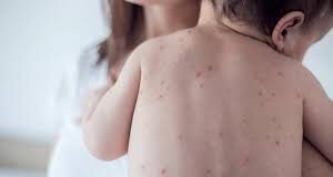 Provincia advierte “un alerta” por la posibilidad de que surja un “brote de sarampión”