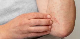 Qué es el lupus, una de las enfermedades autoinmunes más difíciles de diagnosticar